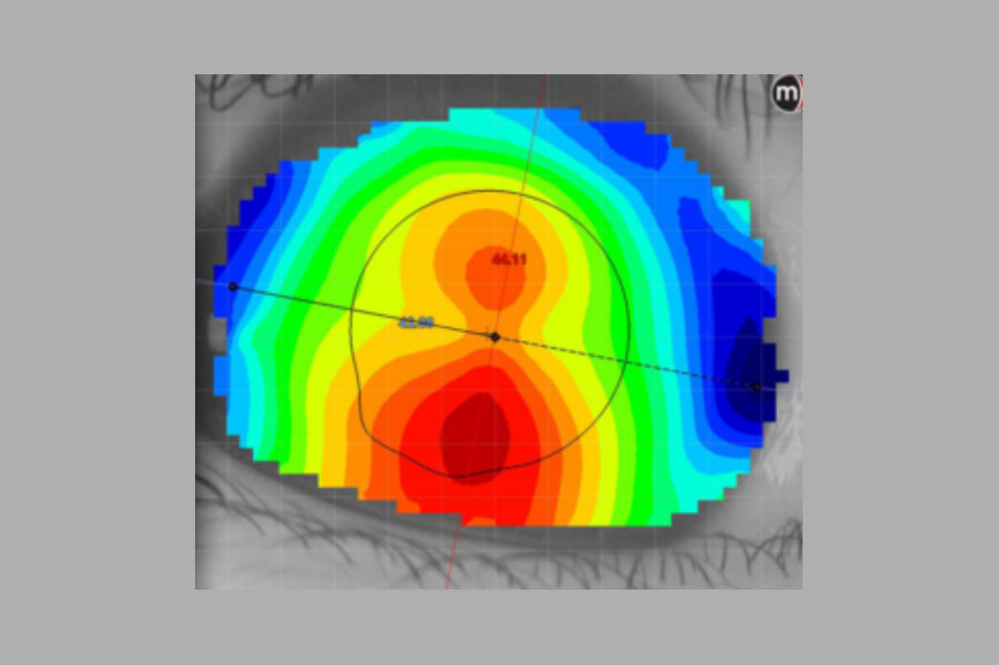 Se ha sugerido que la topografía es el estándar de oro para la adaptación de ortoqueratología porque el mapeo detallado de la córnea permite una adaptación más precisa y una lente hecha a la medida.