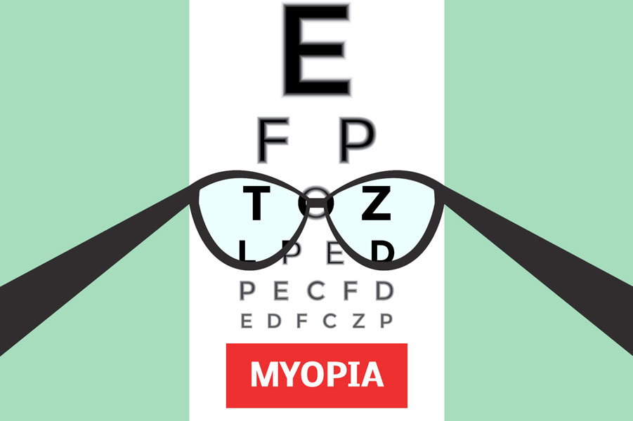 La mejor manera de prevenir el desarrollo de la miopía patológica es evitar una miopía más alta y una longitud axial más larga. Es imprescindible realizar esfuerzos para concienciar sobre la miopía y controlar su progresión en la infancia.