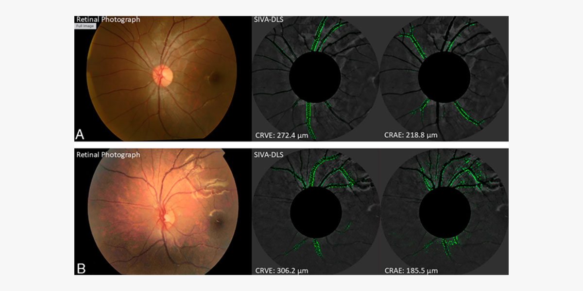 Estudio muestra cómo el ejercicio conduce a una vasculatura retiniana más saludable en niños